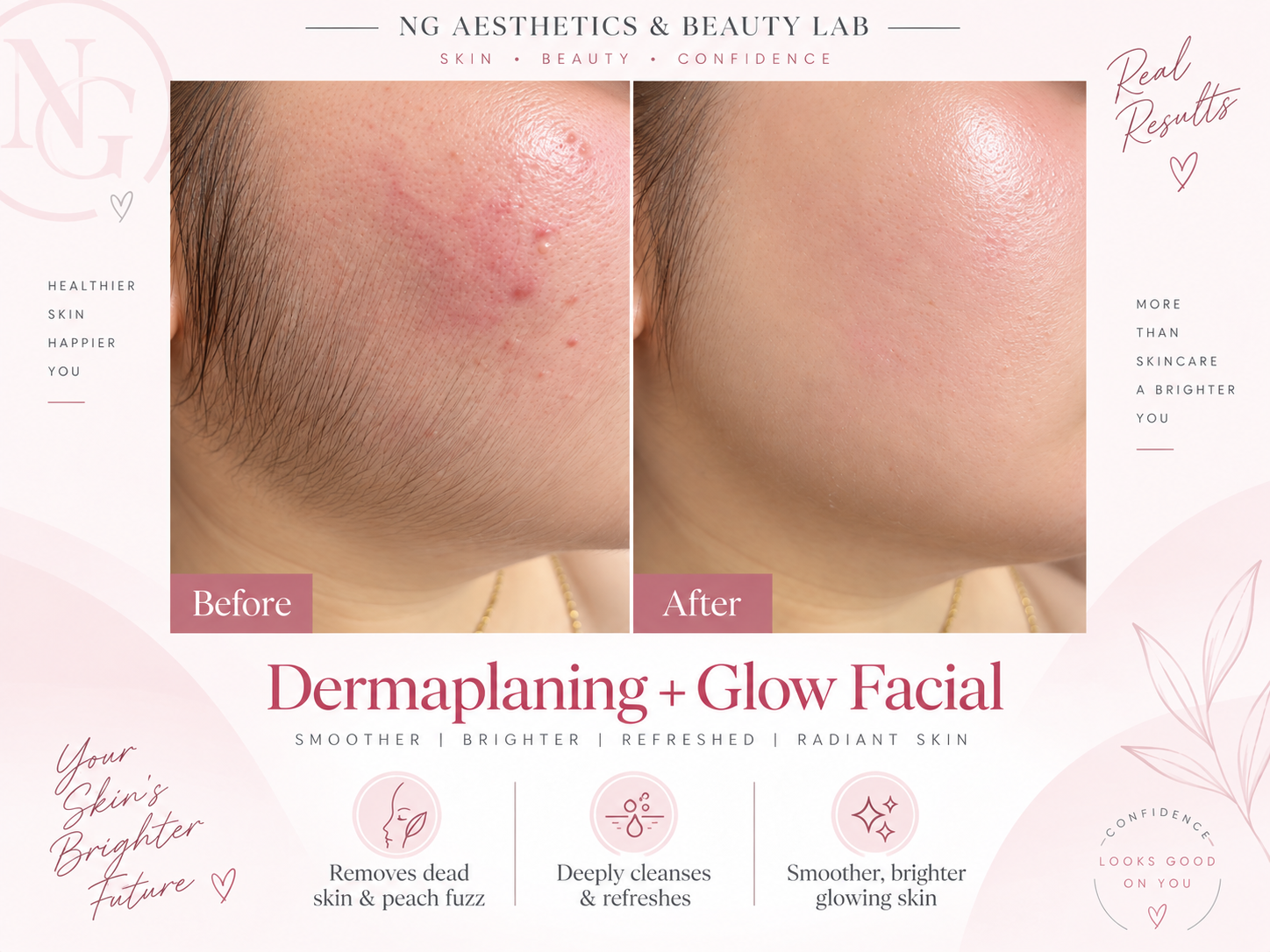 Dermaplaning Facial treatment artwork with side-by-side before and after panels