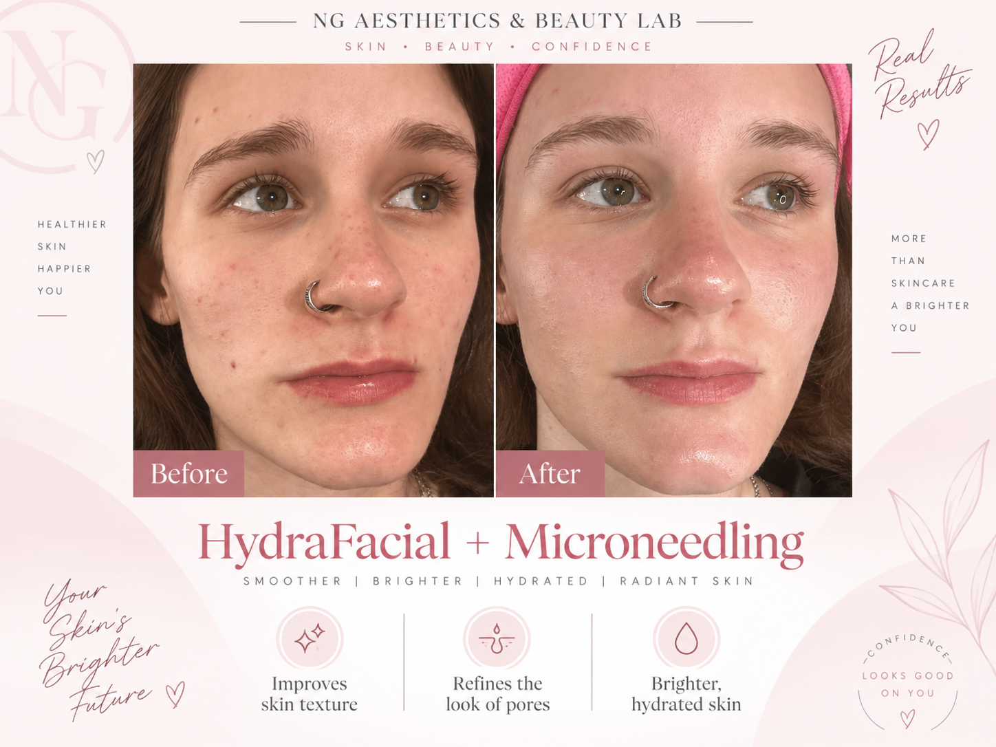 Hydra Facial + Microneedling treatment artwork with side-by-side before and after panels
